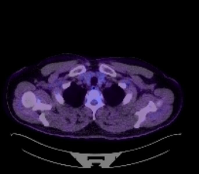 File:Bronchial carcinoid tumor (Radiopaedia 67377-76766 18FDG-PET-CT 16).jpg