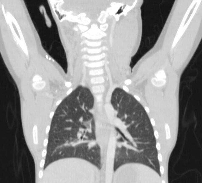 File:Bronchus suis (Radiopaedia 68131-77620 Coronal lung window 21).jpg
