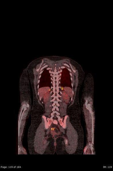 File:Brown fat uptake (FDG PET-CT) (Radiopaedia 77392-89513 Fused coronal 77).jpg