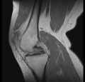 Bucket handle tear - medial meniscus (Radiopaedia 24900-25163 Sagittal T2 6).png