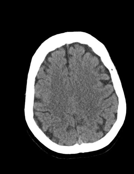 File:Burnt-out meningioma (Radiopaedia 51557-57337 Axial non-contrast 32).jpg