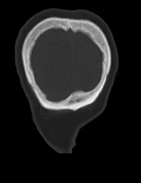 File:Burnt-out meningioma (Radiopaedia 51557-57337 Coronal bone window 51).jpg