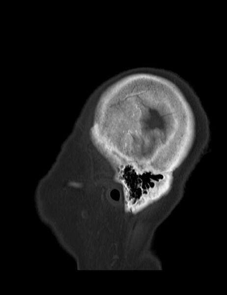 File:Burnt-out meningioma (Radiopaedia 51557-57337 Sagittal bone window 2).jpg