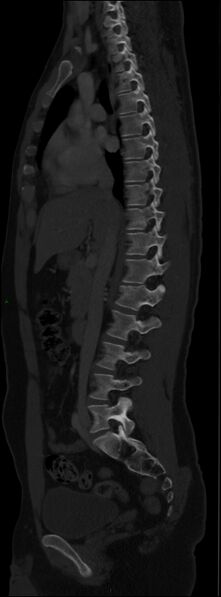 File:Burst fracture (Radiopaedia 83168-97542 Sagittal bone window 62).jpg