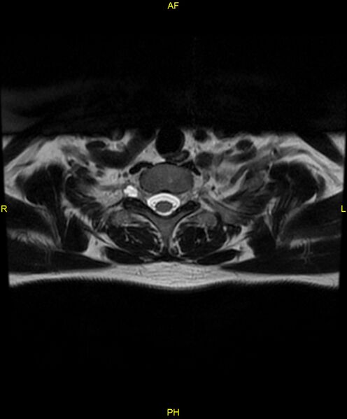File:C5 nerve sheath tumor (Radiopaedia 85777-101596 Axial T2 82).jpg