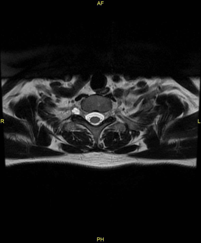 C5 nerve sheath tumor (Radiopaedia 85777-101596 Axial T2 82).jpg