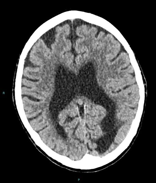 File:Calcified cerebral emboli from left ventricular thrombus (Radiopaedia 84420-99758 Axial non-contrast 40).jpg