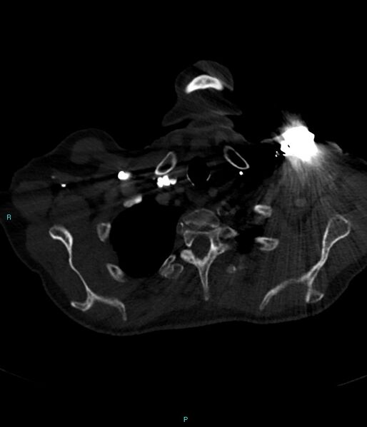 File:Calcified cerebral emboli from left ventricular thrombus (Radiopaedia 84420-99760 Axial bone window 7).jpg