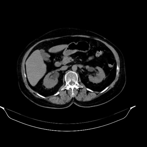 File:Calcified hydatid cyst (Radiopaedia 62000-70085 Axial non-contrast 44).jpg