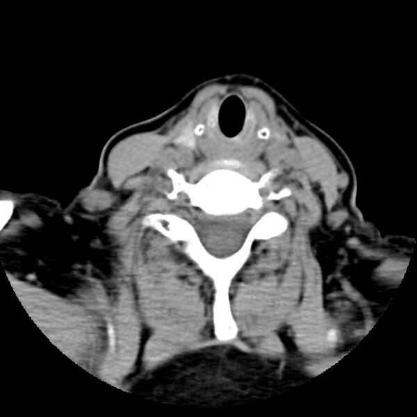 File:Calcified meningioma - cervical canal (Radiopaedia 70136-80171 B 26).jpg