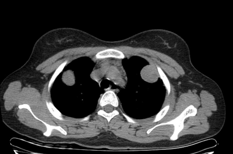 File:Cannonball metastases - uterine choriocarcinoma (Radiopaedia 70137-80173 Axial non-contrast 19).jpg