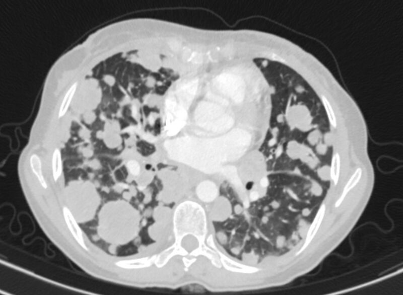 File:Cannonball metastases from breast cancer (Radiopaedia 91024-108569 Axial lung window 55).jpg