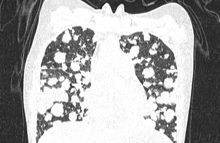 Cannonball metastases from breast cancer (Radiopaedia 91024-108569 Coronal lung window 57).jpg
