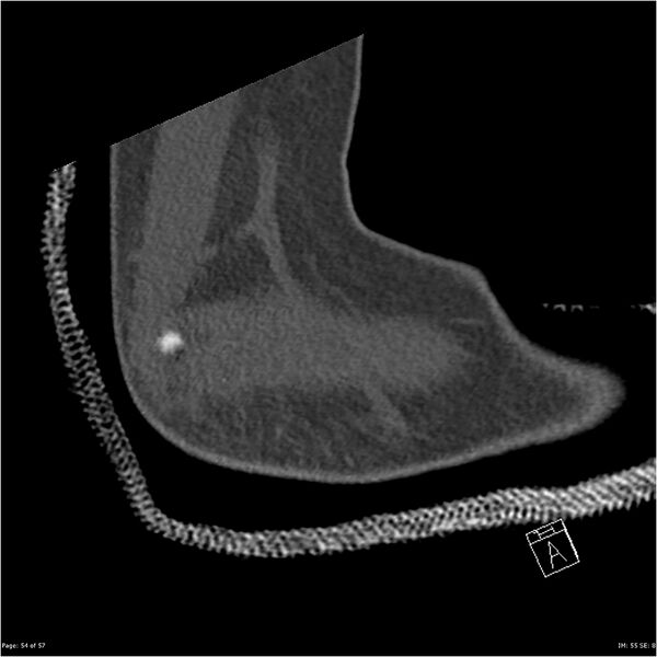 File:Capitellum fracture (Radiopaedia 23352-23426 Sagittal bone window 54).jpg