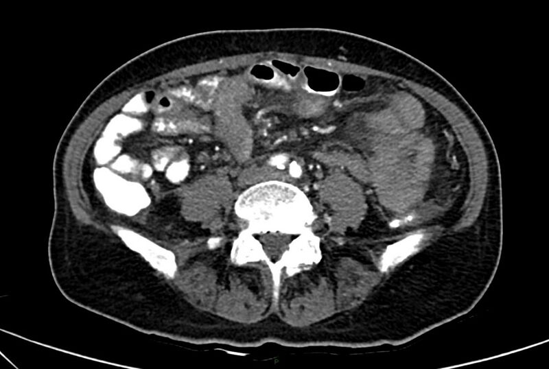 File:Carcinoid mesenteric tumor complicated by chylous ascites (Radiopaedia 76312-88926 A 44).jpg