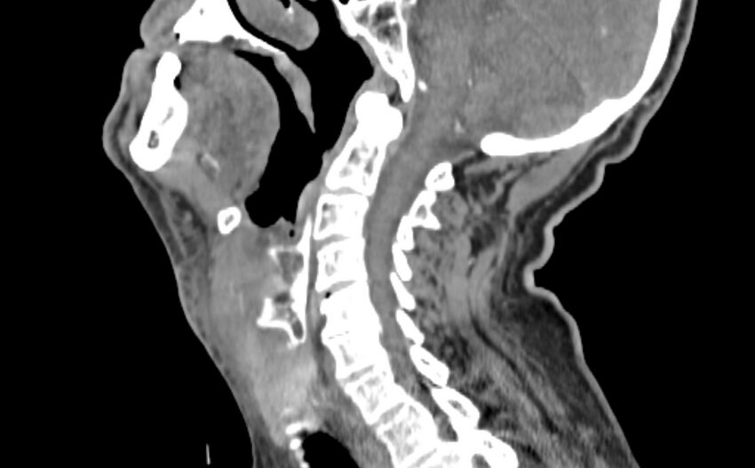 Carotid artery pseudoaneurysm (Radiopaedia 84030-99259 E 9).jpg