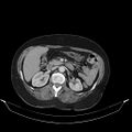 Carotid body tumor (Radiopaedia 21021-20948 A 62).jpg
