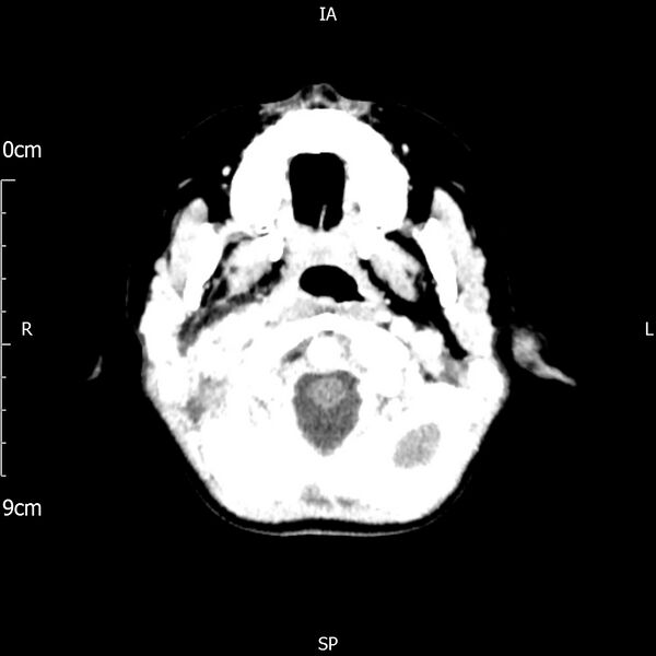 File:Cavernous sinus thrombosis (Radiopaedia 79414-92510 Axial Brain 44).jpg
