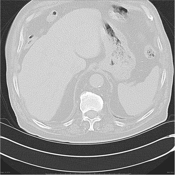 File:Cavitating left lower lobe lesion - squamous cell lung cancer (Radiopaedia 27749-28176 Axial lung window 47).jpg