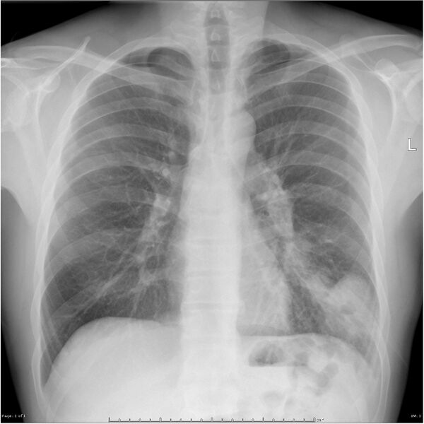File:Cavitating lung cancer (Radiopaedia 25796-25944 Frontal 1).jpg