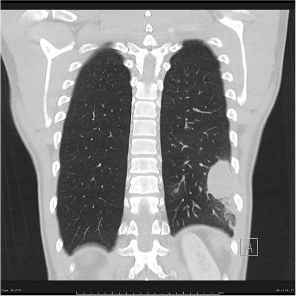 File:Cavitating lung cancer (Radiopaedia 25796-25945 lung window 36).jpg