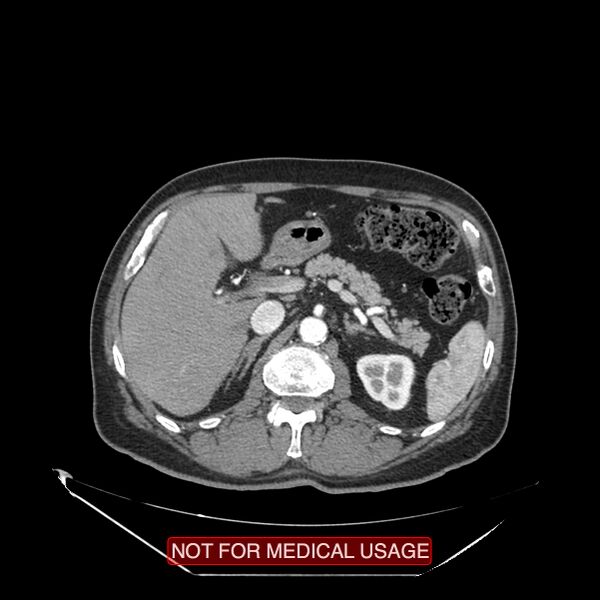 File:Celiac trunk variant anatomy - gastrohepatic trunk and splenic artery (Radiopaedia 38815-40995 A 26).jpg
