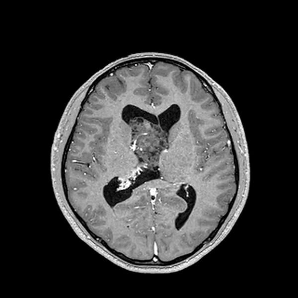 File:Central neurocytoma (Radiopaedia 79320-92380 Axial T1 C+ 135).jpg