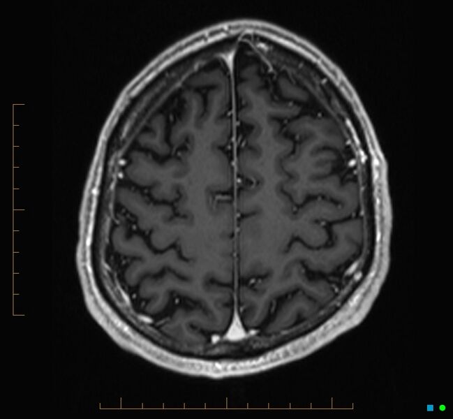 File:Cerebellar gangliocytoma (Radiopaedia 65377-74422 Axial T1 C+ 113).jpg