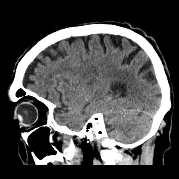 File:Cerebellar hemorrhage (Radiopaedia 27193-27359 C 14).jpg
