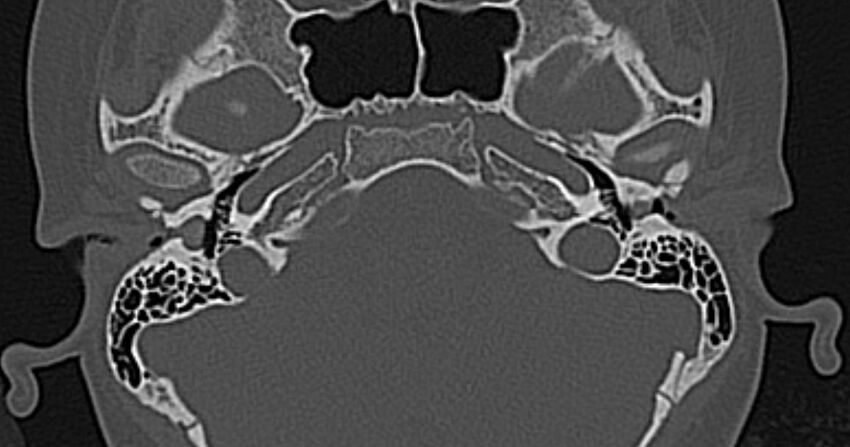 Cerebellopontine angle lipoma (Radiopaedia 57303-64242 Axial bone window 17).jpg