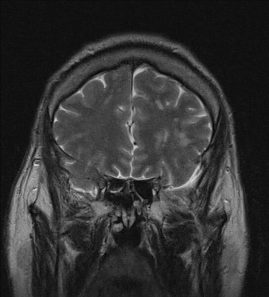 File:Cerebellopontine angle meningioma (Radiopaedia 24459-24764 Coronal T2 5).jpg