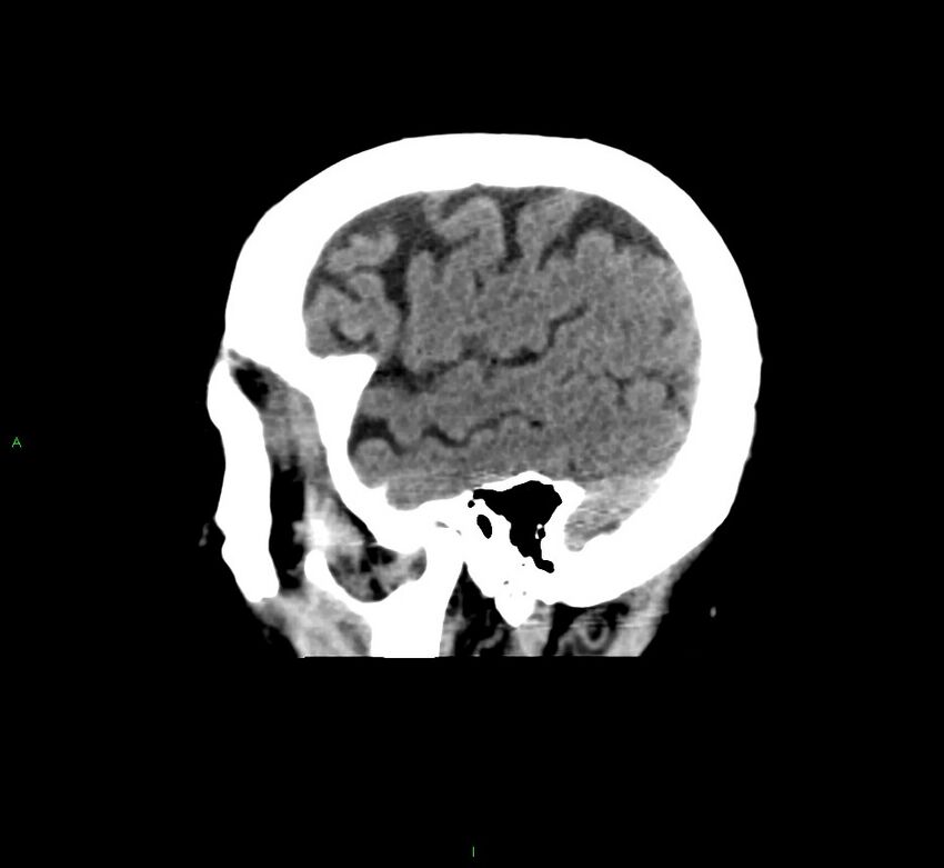 Cerebral amyloid angiopathy-associated lobar intracerebral hemorrhage (Radiopaedia 58376-65511 C 10).jpg