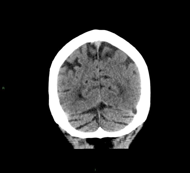 File:Cerebral amyloid angiopathy-associated lobar intracerebral hemorrhage (Radiopaedia 58376-65511 Coronal non-contrast 15).jpg