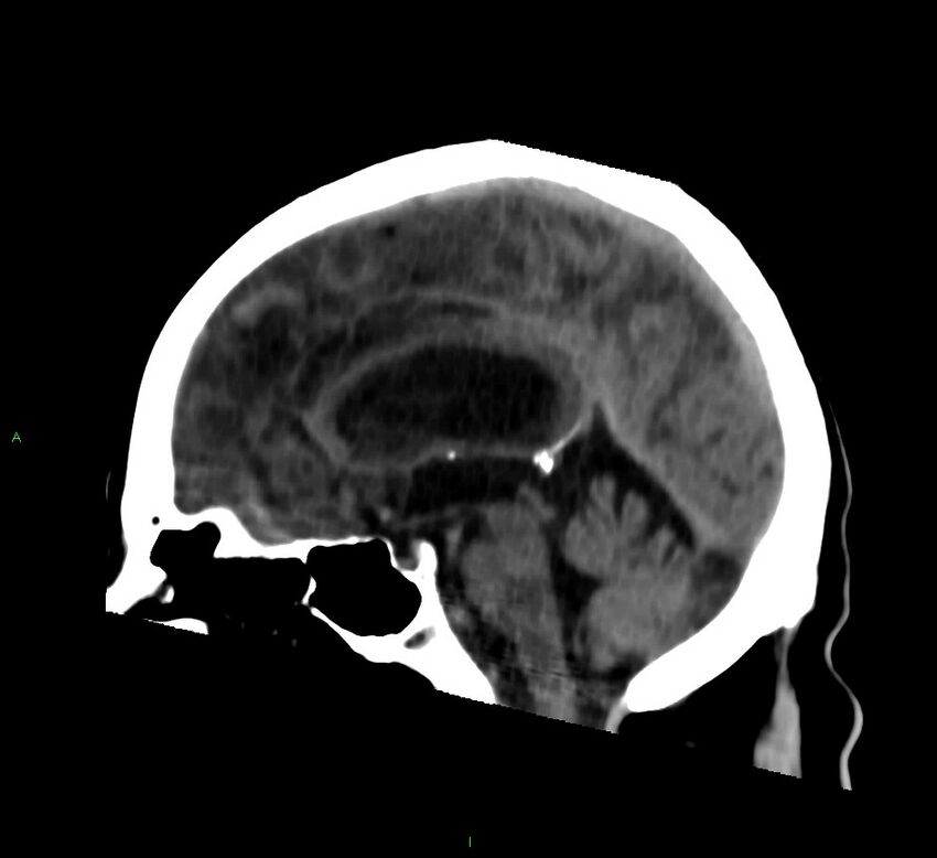 Cerebral amyloid angiopathy-associated lobar intracerebral hemorrhage (Radiopaedia 58376-65513 C 38).jpg