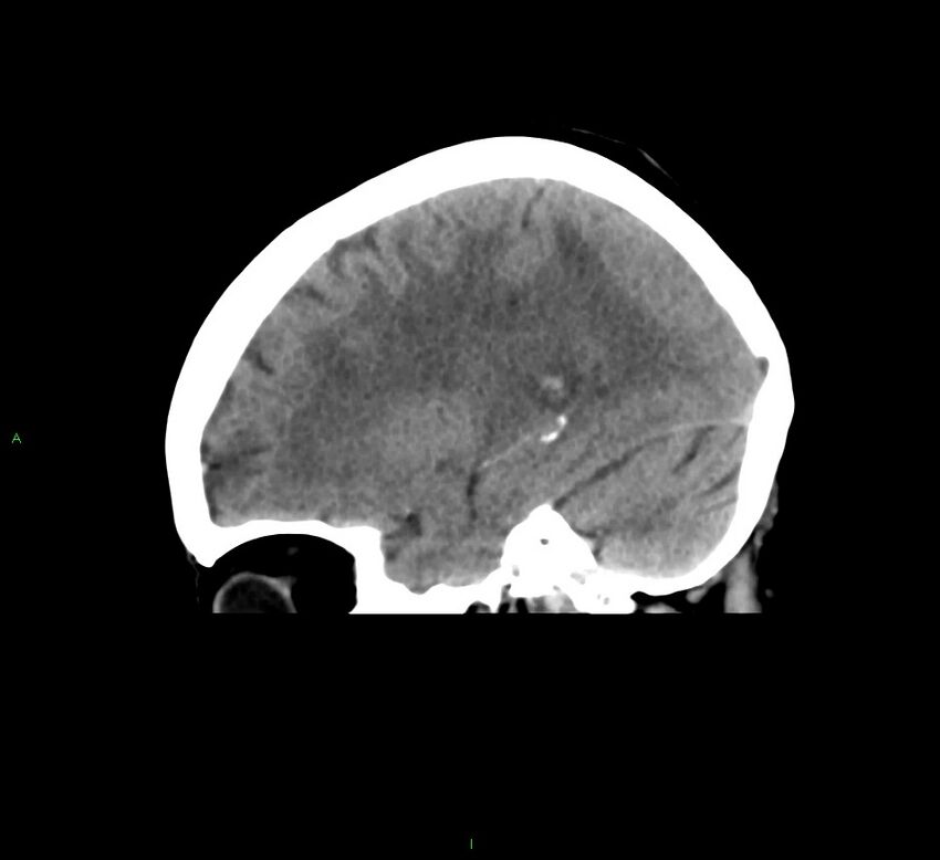 Cerebral amyloid angiopathy-associated lobar intracerebral hemorrhage (Radiopaedia 58378-65516 C 17).jpg
