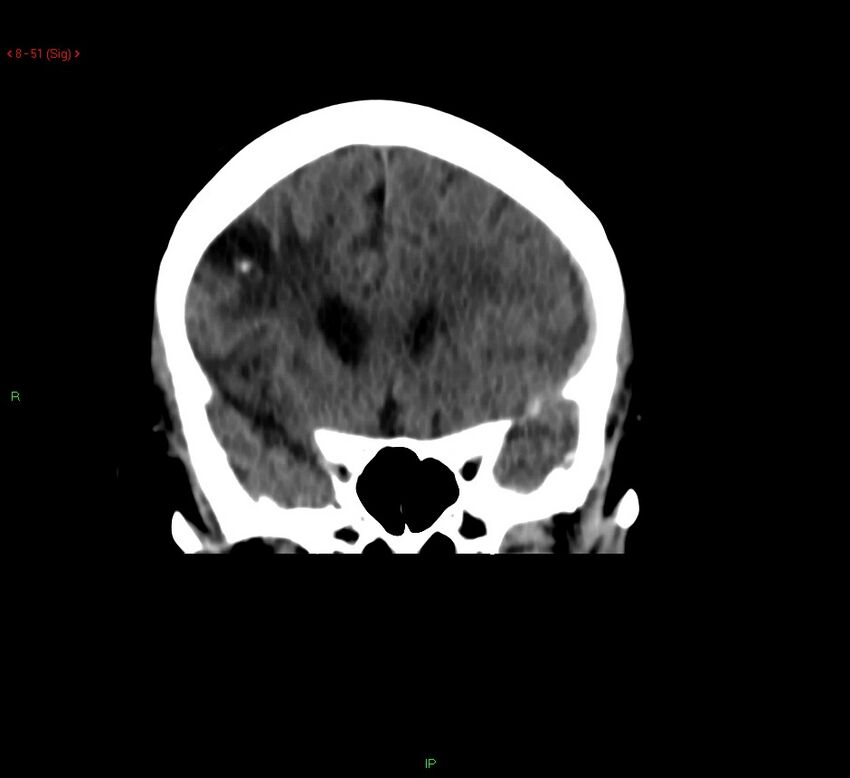 Cerebral amyloid angiopathy-associated lobar intracerebral hemorrhage (Radiopaedia 58378-65518 Coronal non-contrast 51).jpg