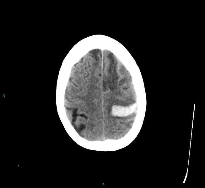 File:Cerebral amyloid angiopathy-associated lobar intracerebral hemorrhage (Radiopaedia 58529-65681 Axial non-contrast 11).jpg