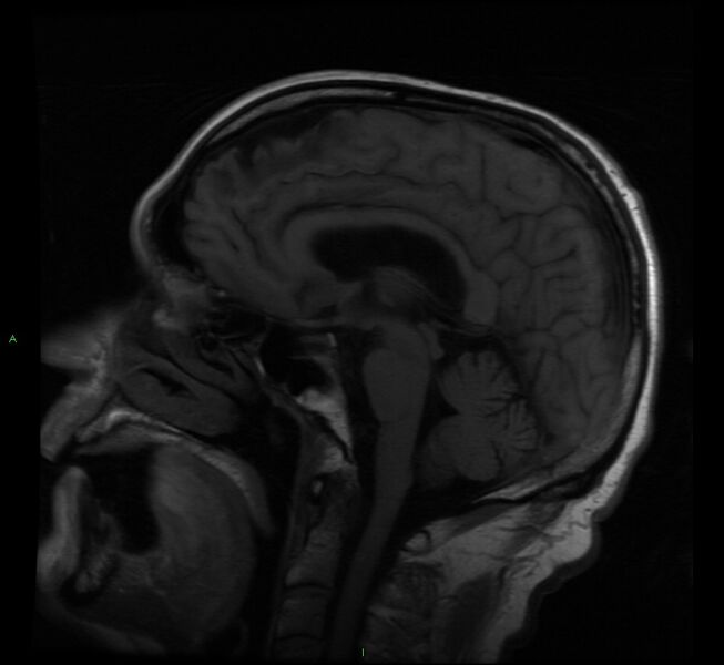 File:Cerebral amyloid angiopathy-associated lobar intracerebral hemorrhage (Radiopaedia 58529-65684 Sagittal T1 11).jpg