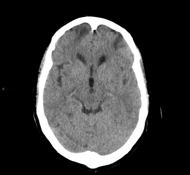 File:Cerebral amyloid angiopathy-associated lobar intracerebral hemorrhage (Radiopaedia 58529-65686 Axial non-contrast 10).jpg