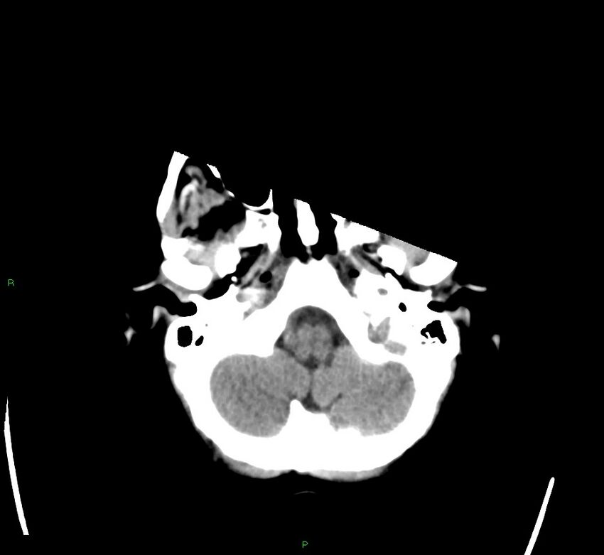 Cerebral amyloid angiopathy-associated lobar intracerebral hemorrhage (Radiopaedia 58563-65727 Axial non-contrast 46).jpg