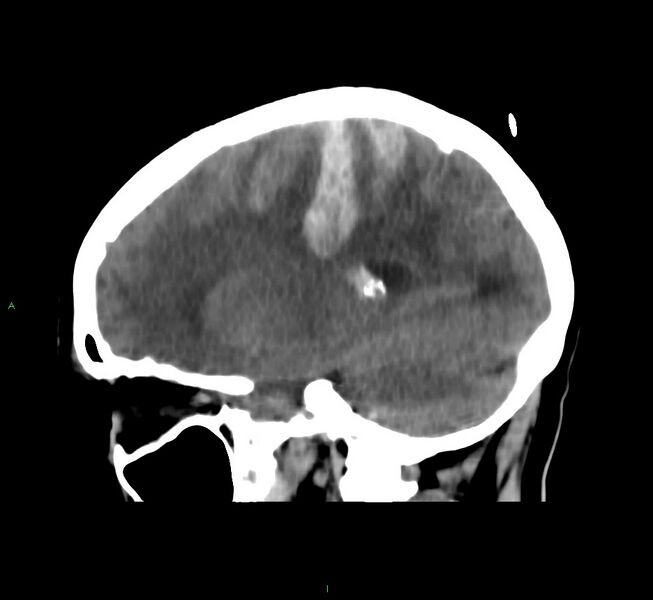 File:Cerebral amyloid angiopathy-associated lobar intracerebral hemorrhage (Radiopaedia 58566-65730 C 19).jpg
