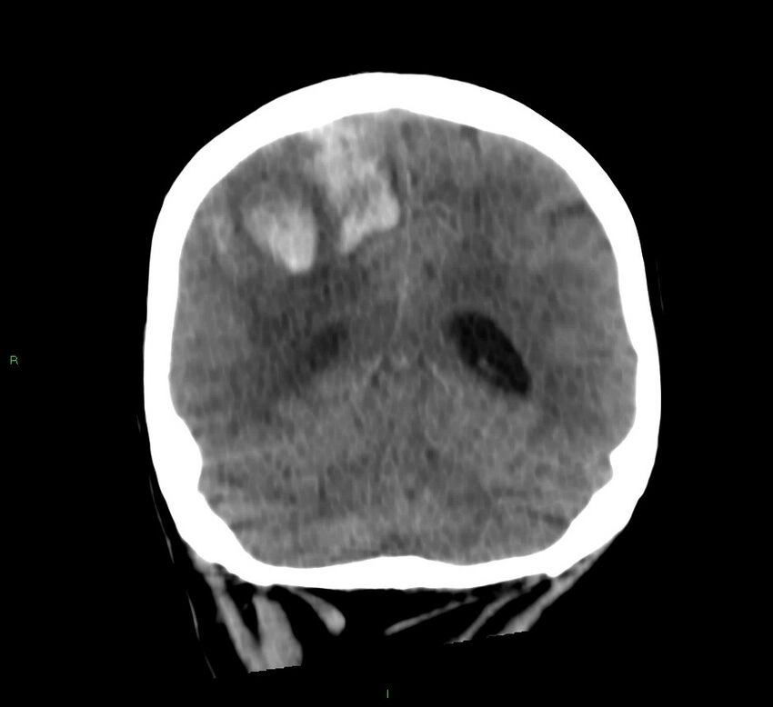 Cerebral amyloid angiopathy-associated lobar intracerebral hemorrhage (Radiopaedia 58566-65730 Coronal non-contrast 25).jpg