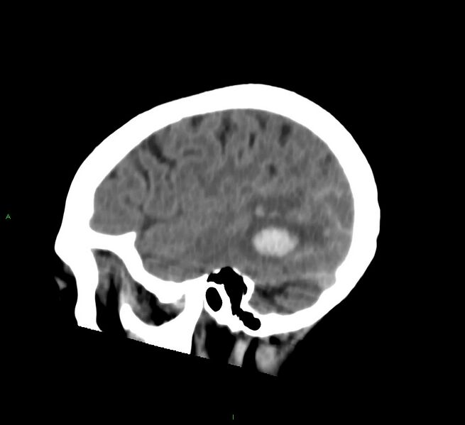 File:Cerebral amyloid angiopathy-associated lobar intracerebral hemorrhage (Radiopaedia 58757-65978 C 43).jpg