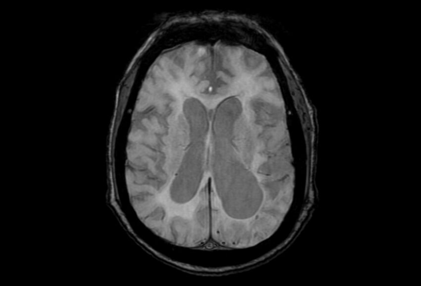 Cerebral amyloid angiopathy (Radiopaedia 86671-102792 Axial Gradient Echo 23).jpg
