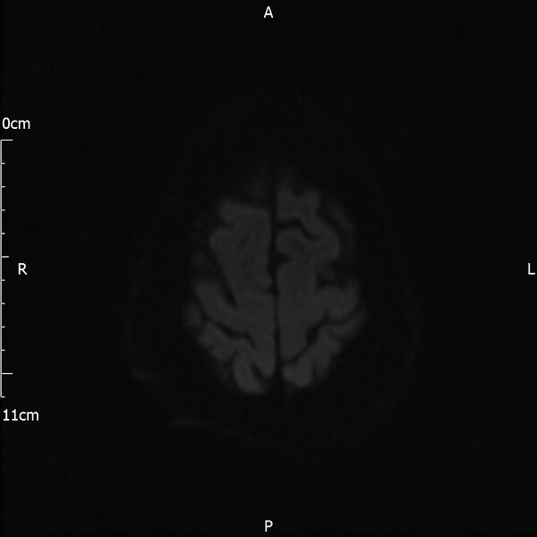 File:Cerebral amyloid angiopathy related inflammation (Radiopaedia 72772-83415 Axial DWI 67).jpg