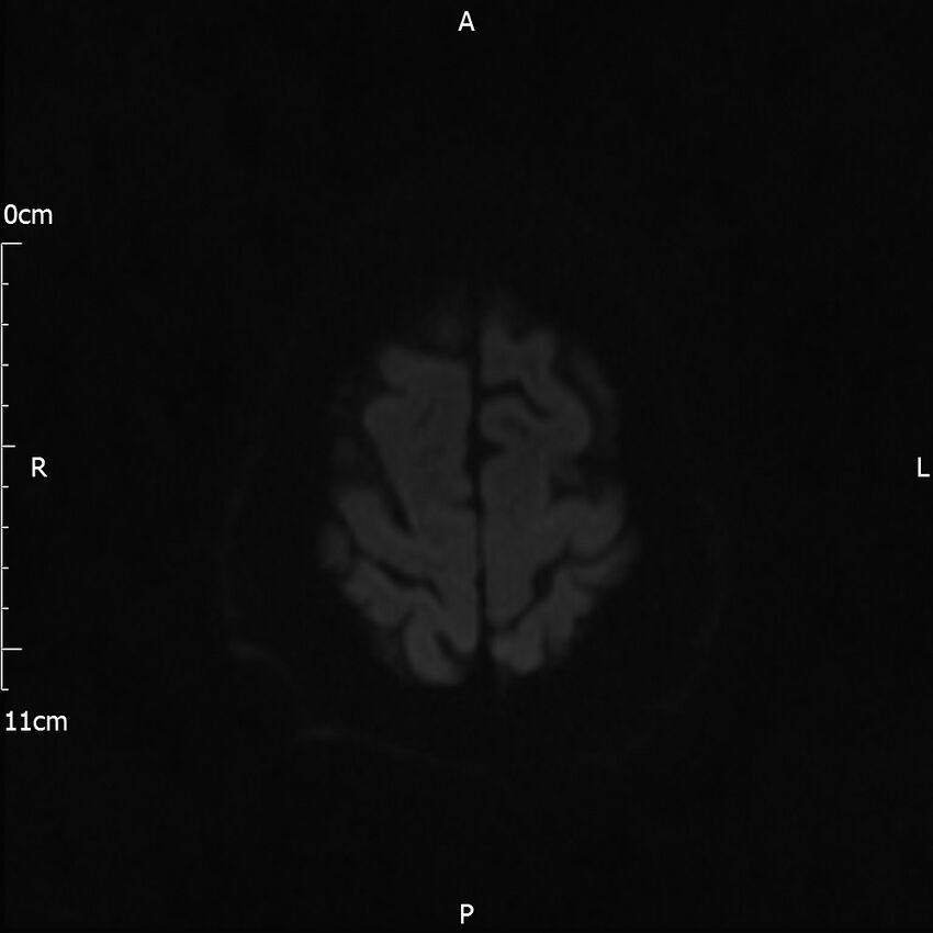 Cerebral amyloid angiopathy related inflammation (Radiopaedia 72772-83415 Axial DWI 67).jpg