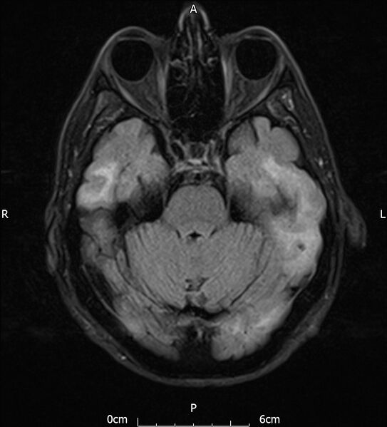 File:Cerebral amyloid angiopathy related inflammation (Radiopaedia 72772-83415 Axial FLAIR 8).jpg