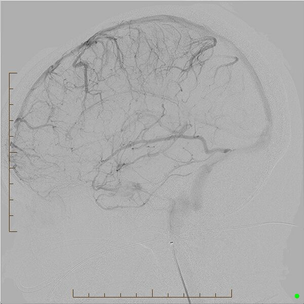 File:Cerebral arteriovenous malformation (AVM) (Radiopaedia 78162-90707 B 17).jpg
