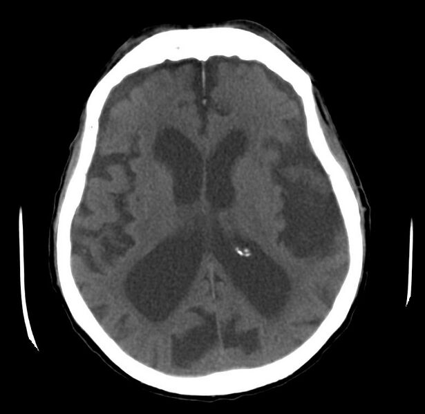 File:Cerebral atrophy (Radiopaedia 11287-11651 B 1).jpg