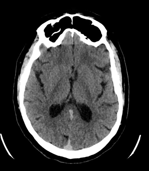 File:Cerebral dural venous sinus thrombosis (Radiopaedia 86514-102575 Axial non-contrast 23).jpg